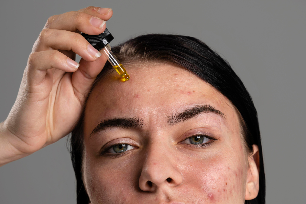 Nega kod akni na licu za problematičnu kožu